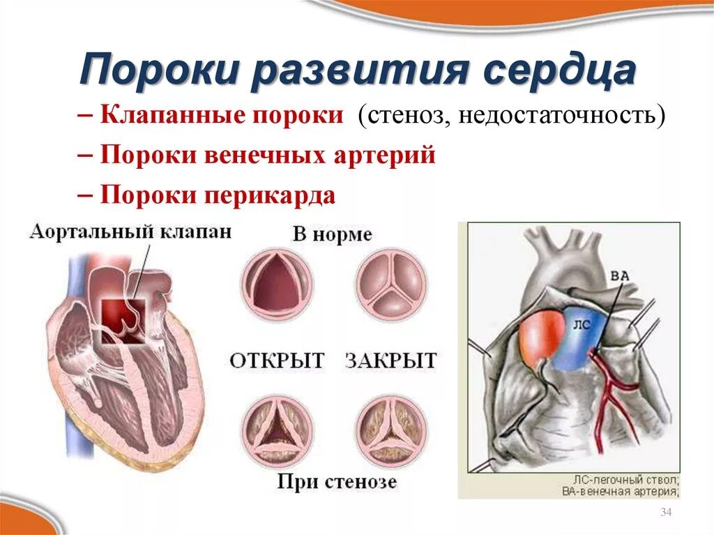 Клапанные пороки стеноз недостаточность. Приобретенные пороки сердца морфология. Врожденные клапанные пороки сердца. Пороки сердца стенозы клапанов недостаточность клапанов.