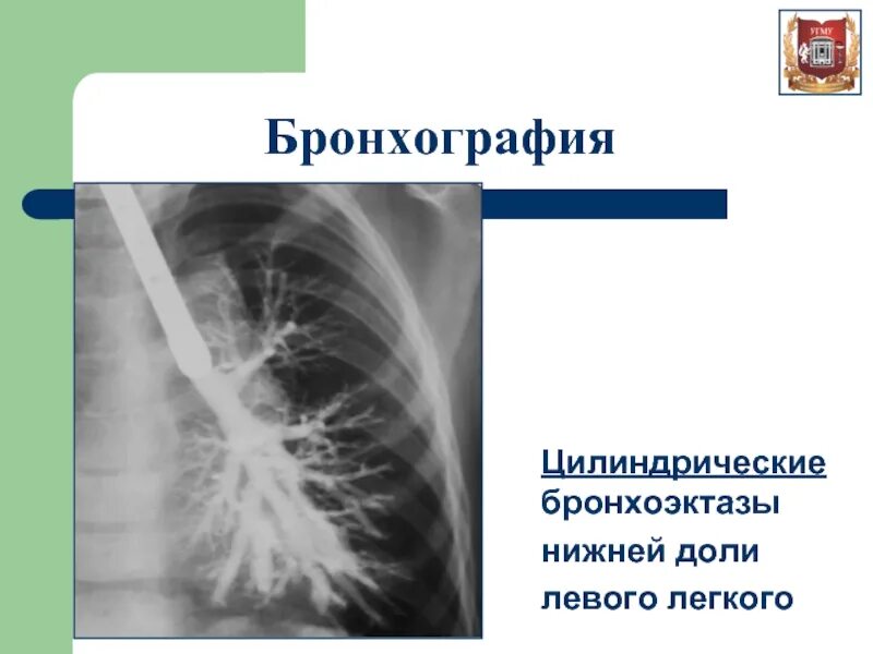 Бронхит бронхоэктатическая болезнь. Бронхоэктатическая болезнь бронхография. Бронхография цилиндрические бронхоэктазы. Бронхоэктазы рентген бронхография.