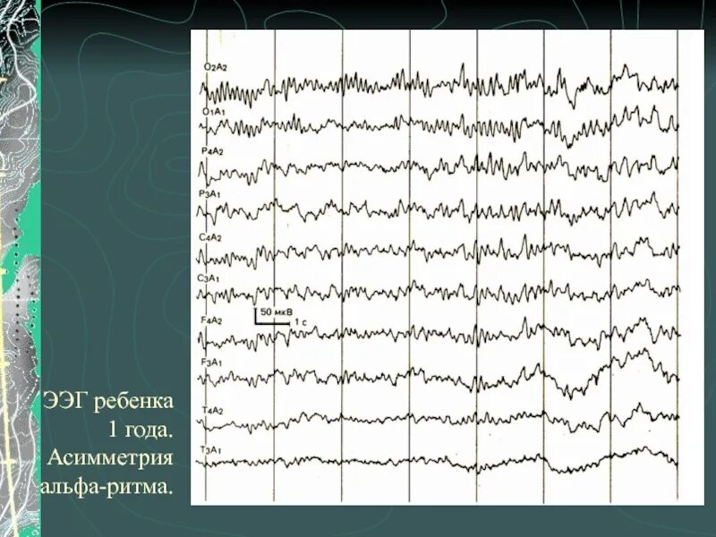 Ээг 6. Ритмы ЭЭГ. Электроэнцефалография. Энцефалограмма Альфа ритм. Ритмы ЭЭГ физиология.