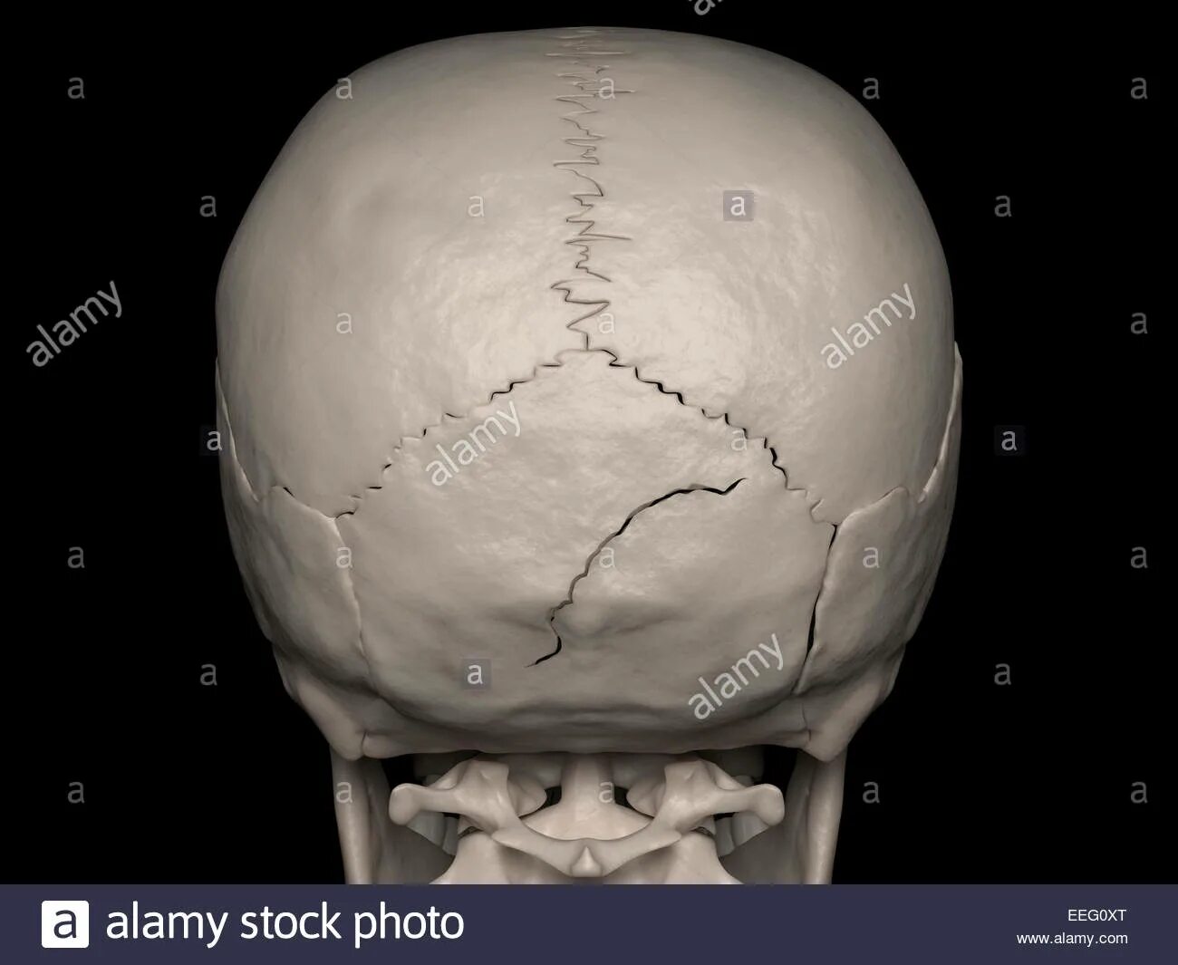 Трещина черепа у ребенка. Перелом затылочной кости черепа. Трещина затылочной кости. Линейный перелом затылочной кости.