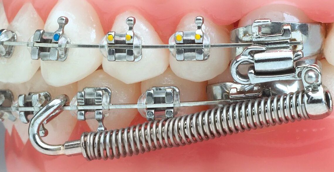 Аппарат хасса. Ортодонтический аппарат Форсус. Форсус аппарат для дистального прикуса.