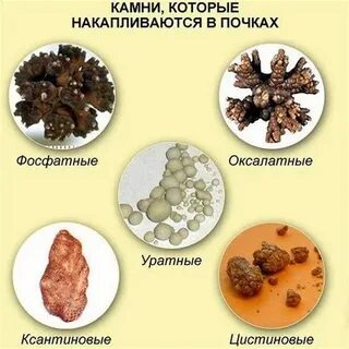 Оксалатные камни в почках причины