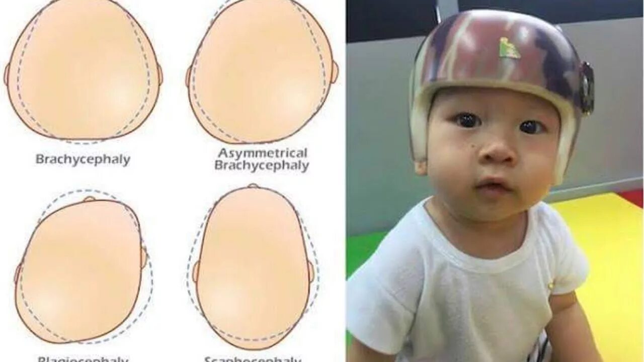 Шлем для формы головы. Шлемы для детей эпилепсии. Шлем для выравнивания головы у ребенка. Шлем для выравнивания головы. Каска для детей для формы головы.