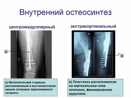 Остеосинтез это
