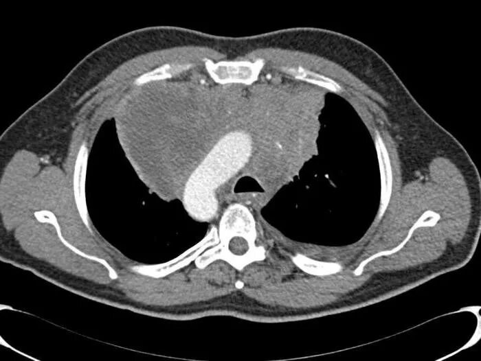 Лимфома средостения на кт. Кт грудной клетки срезы аксиальные. Компьютерная томография кт грудной клетки. Медиастинальная лимфома кт.