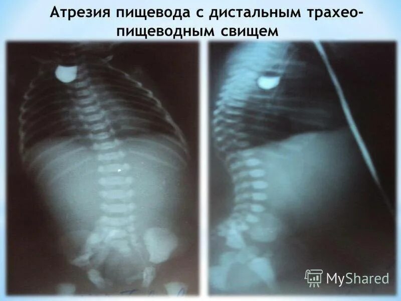 Пищевод у новорожденного. Атрезия пищевода контрастное исследование. Рентген при атрезии пищевода. ВПР ЖКТ атрезия пищевода. Атрезия пищевода с трахеопищеводным свищом.