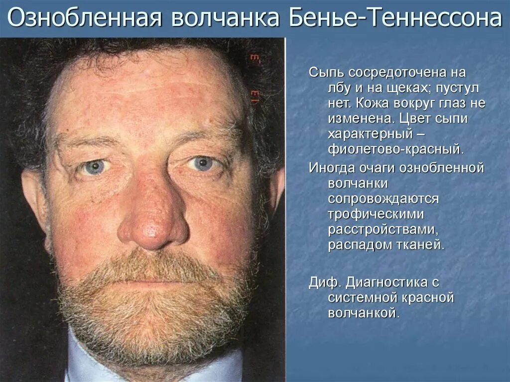 Могул ли мои симптомы указывать на СКВ? - Вопрос ревматологу - 03 Онлайн