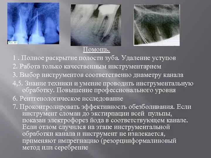 Моляр в разрезе. Эндодонтического отбеливания. 8 конфигураций полости зуба. Коренной зуб с четырьмя каналами. Препарирование верхнего моляра.