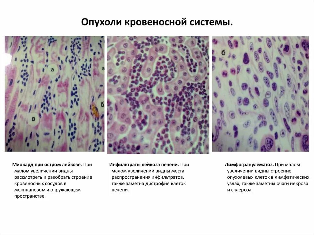 Лимфолейкоз гистология. Лейкозная инфильтрация почки микропрепарат. Острый лимфолейкоз микропрепарат. Макропрепарат печени при остром лимфобластном лейкозе.