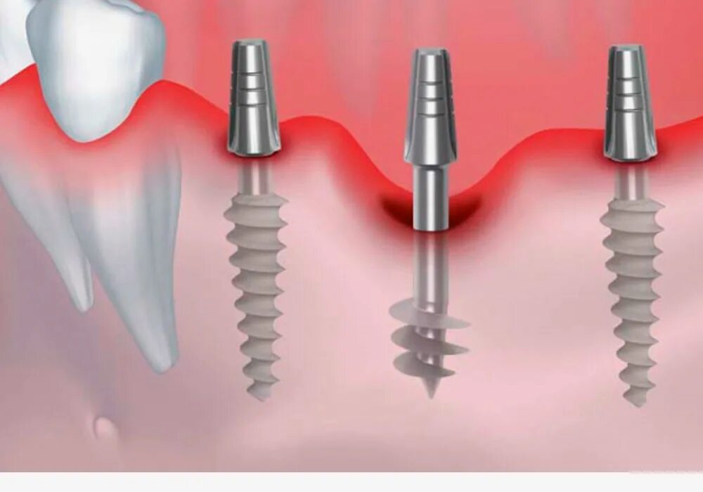Имплант лайн. Базальная имплантация Biomed. Базальная имплантация зубов.