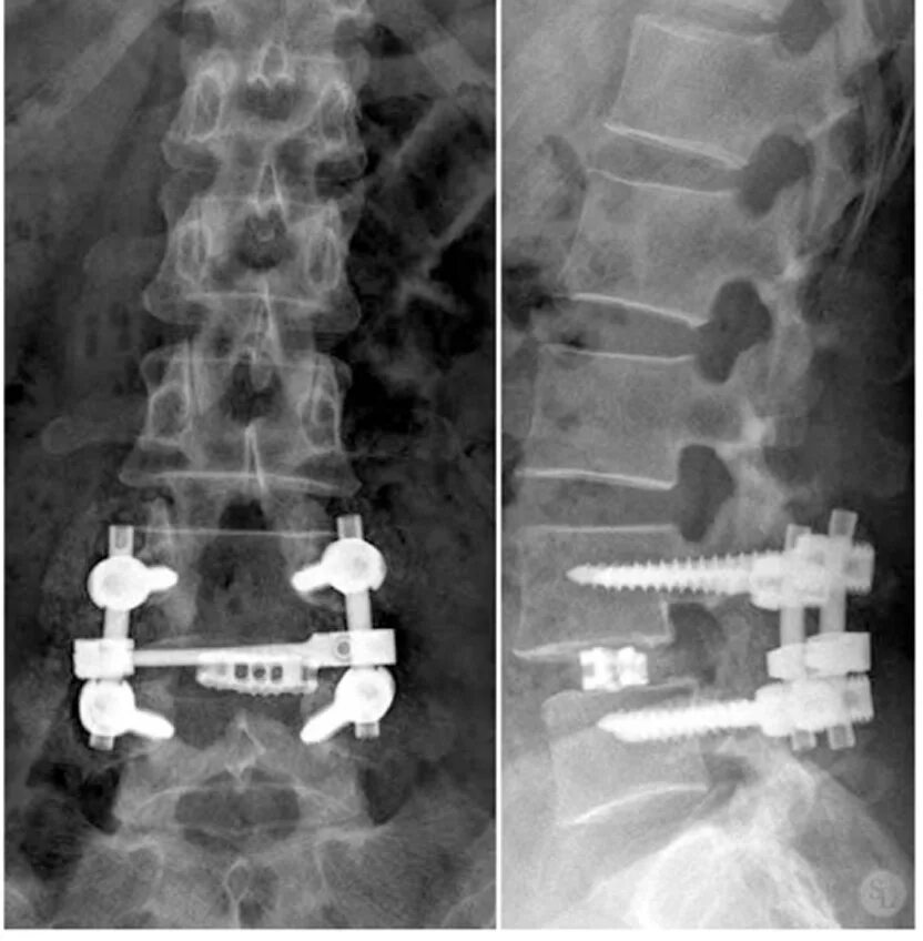 Транспедикулярная фиксация l5-s1 позвонков. Спондилолистез с4. Транспедикулярная фиксация позвоночника l4-l5. Спондилолизный спондилолистез l4 l5 позвонка. Конструкция позвоночника операция