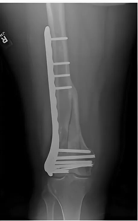 Накостный остеосинтез бедренной кости. Остеосинтез бедра пластиной рентген. Остеосинтез бедренной кости пластиной. Остеосинтез диафиза бедра рентген.