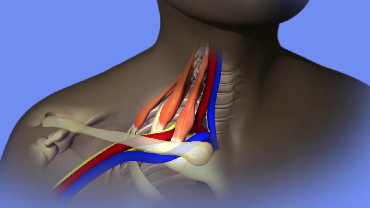 Подключичный тромбоз. Синдром подключичной вены. Тромбоз подключичной вены (синдром Педжета-Шретера).. Синдром верхней апертуры грудной клетки. Клиника тромбоза подключичной вены.