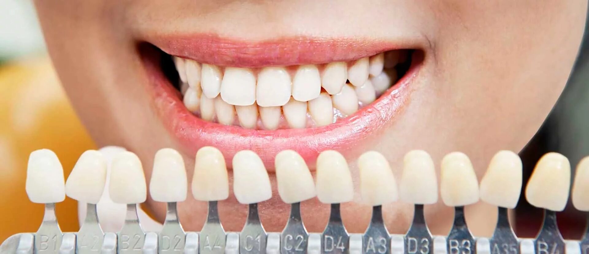 Зубы и т д. Металлокерамическая коронка цвет а2. Палитра Emax а 1 цвет зубов.