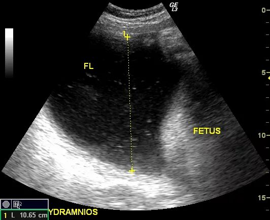 Узи литр воды. Измерение околоплодных вод на УЗИ. Взвесь в околоплодных Водах на УЗИ. Амниотическая жидкость с гиперэхогенной взвесью.