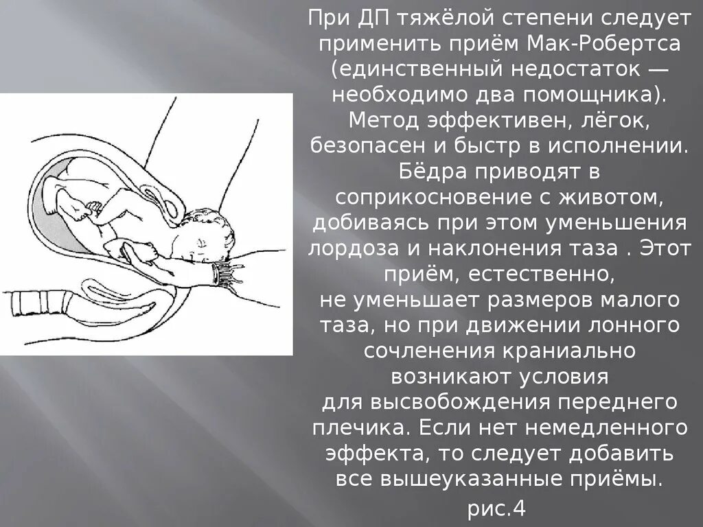 Мак робертса. Мак робертса при дистоции плечиков. дистоция плечиков симптом черепахи. акушерское пособие при дистоции плечиков. приемы при дистоции плечиков.