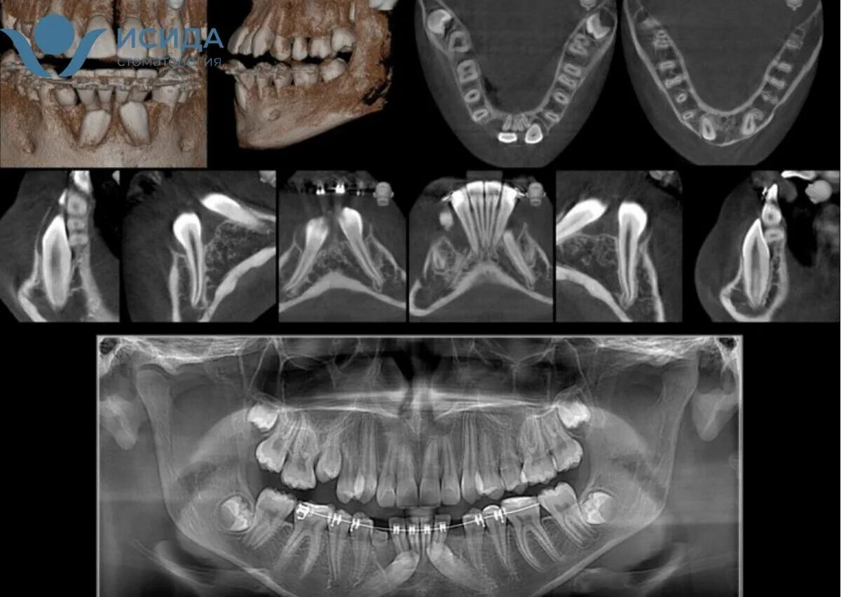 Зубы и т д. Кт 15х15 верхней и нижней челюсти. Кт 3д зубочелюстной системы. Кт 3d верхней и нижней челюсти.