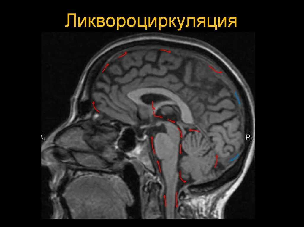 Расширенные ликворные пространства. Киста цистерны четверохолмия кт. Цистерна Меккеля головной мозг. Ликвородинамика головного мозга мрт. Ликворная система головного мозга мрт.