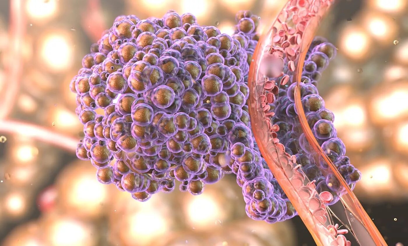 Metastasis
