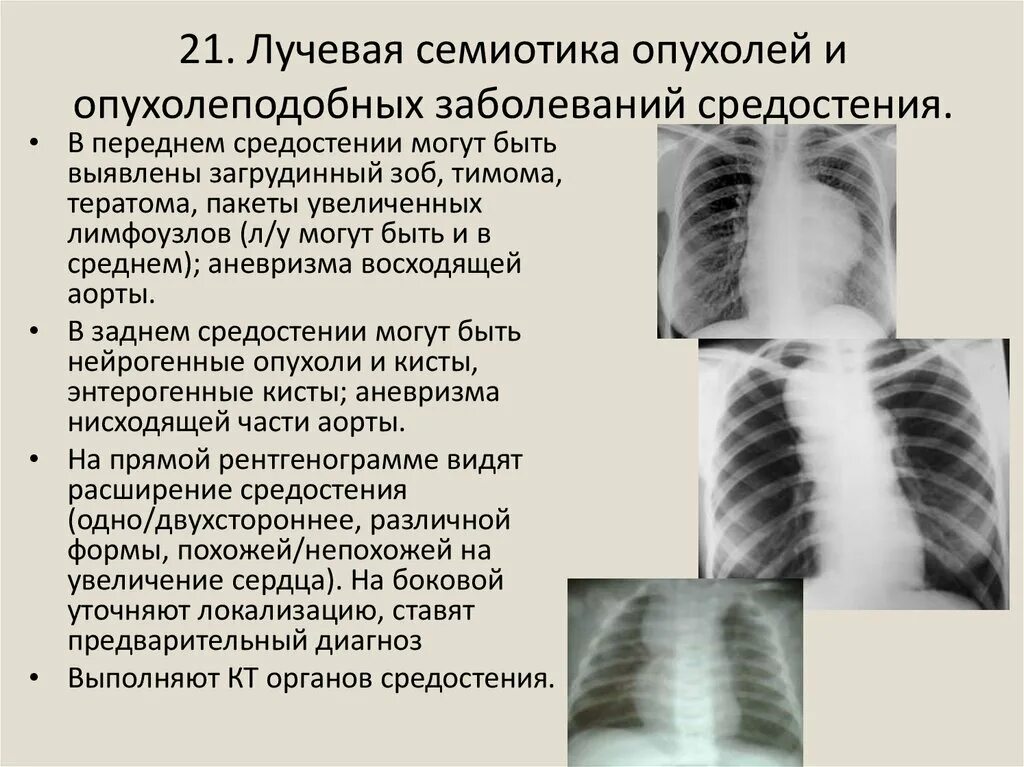 Лучевые заболевания легких. Злокачественная опухоль средостения рентген схема. Злокачественная опухоль средостения рентген. Рентген картина опухоли средостения. Доброкачественная опухоль средостения рентген.