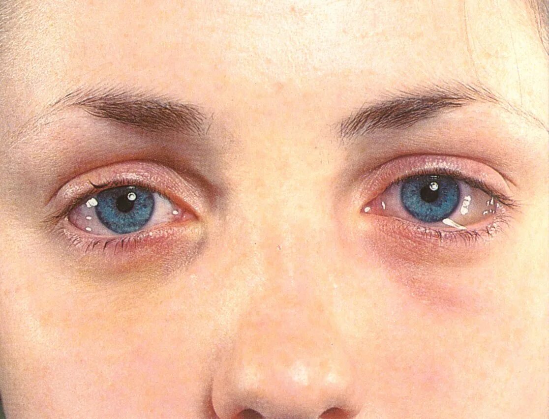 Pterygium causes, treatments and surgery - Clinica Sancho