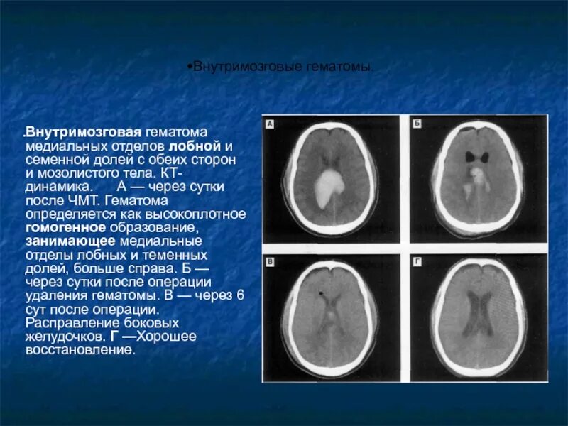 Внутримозговая гематома при ЧМТ кт. Кт мозга внутримозговая гематома. Медиальная внутримозговая гематома кт. Гематома мозолистого тела кт. Гематома мозга операция