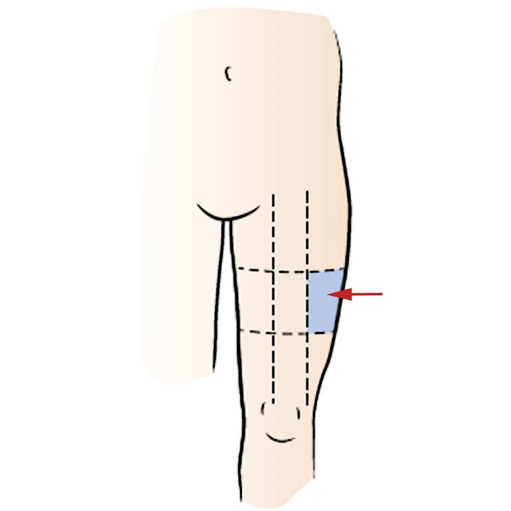 Место уколов в бедро