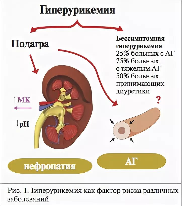Гиперурикемия что. Гиперурикемия. причины гиперурикемии. гиперурикемия симптомы. гиперурикемия и подагра.