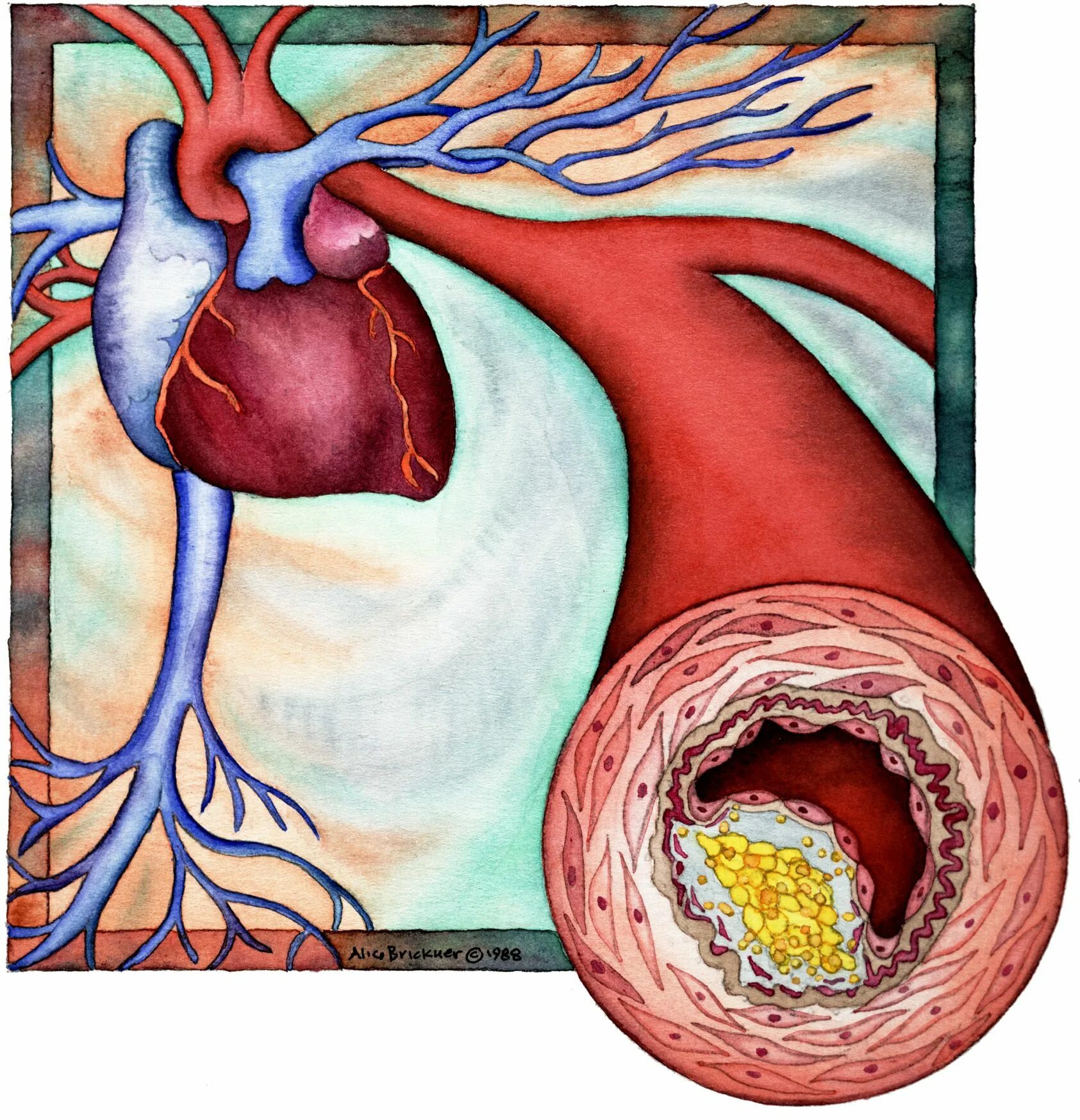 Холестериновые бляшки в сосудах сердца. Хроническое заболевание сосудов