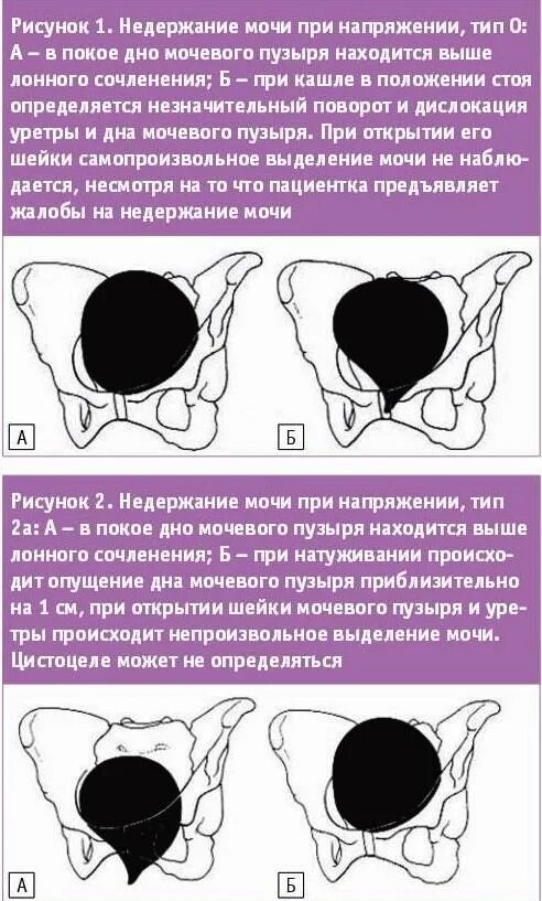 Тренировка мочевого пузыря. Упражнения кегеля для женщин при недержании мочи. мочевой пузырь недержание. упражнения для мочевого пузыря при недержании. стрессовое недержание мочи упражнения.