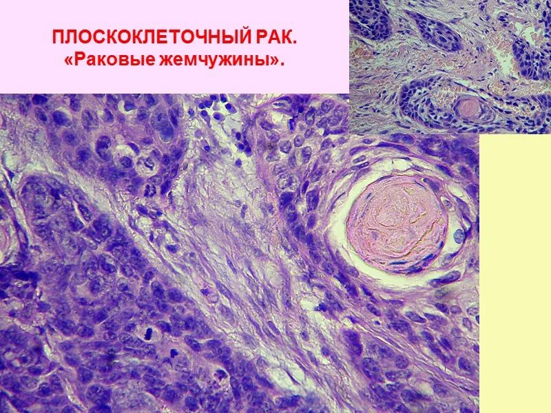 Файл:Squamous cell carcinoma (medium differentiated).jpg - Вікіпедія