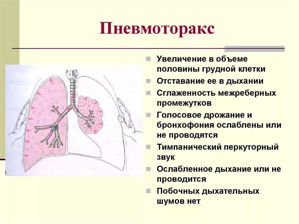 Звук в легких при дыхании. Факторы риска спонтанного пневмоторакса. При пневмотораксе у взрослого объем грудной клетки:. Пневмоторакс физиология дыхания. Спонтанный пневмоторакс пропедевтика.