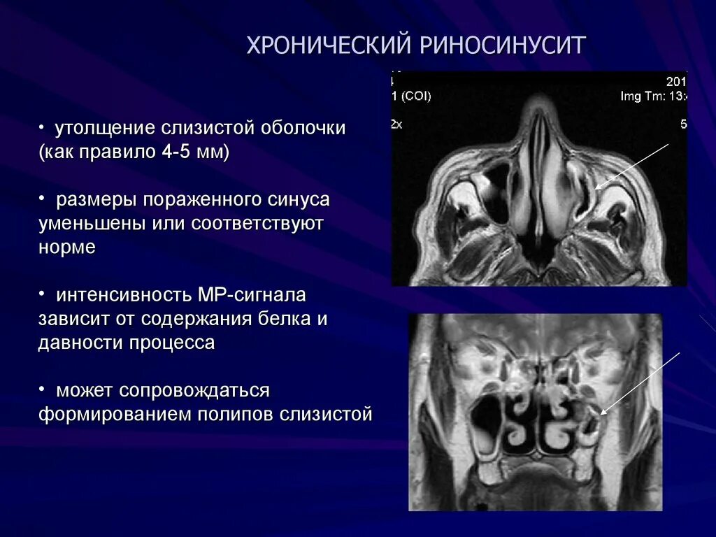 Локальное утолщение слизистой верхнечелюстной пазухи на кт. Гипертрофия слизистой оболочки носовых пазух. Синусит решетчатой кости. Гипертрофия слизистой верхнечелюстных пазухи мрт.