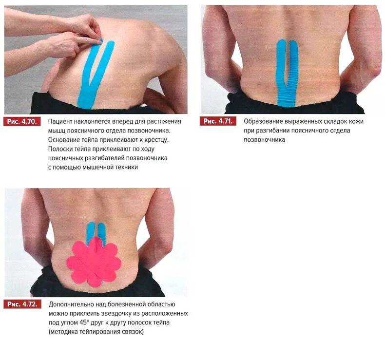 Тейпирование спины при болях. Схема тейпирования при болях в пояснице. Кинезио-тейп лента для осанки спины. Тейпирование спины при грыже поясничного отдела. Тейпирование при грыже поясничного крестцового отдела позвоночника.
