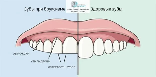 Как выглядит стираемость зубов Бруксизм: лечение в Торревьехе Испания Ап дента