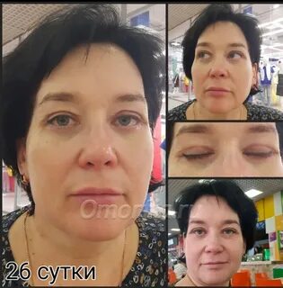 Продолжение операции