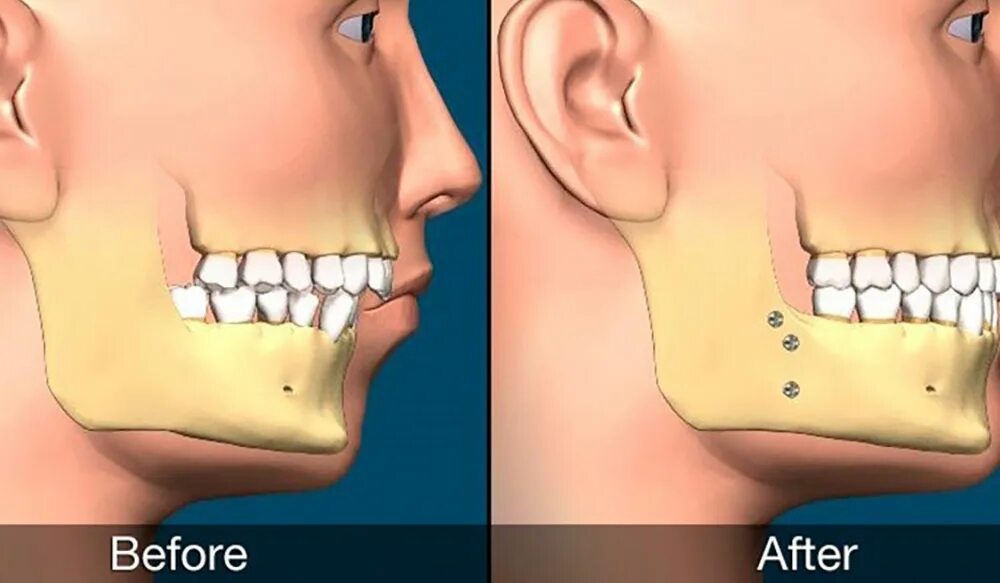 Ортогнатическая операция дистальный прикус. Ортогнатия мезиальный прикус. ЧЛХ операция дистальный прикус. Остеотомия дистальный прикус. Расширение челюсти цена