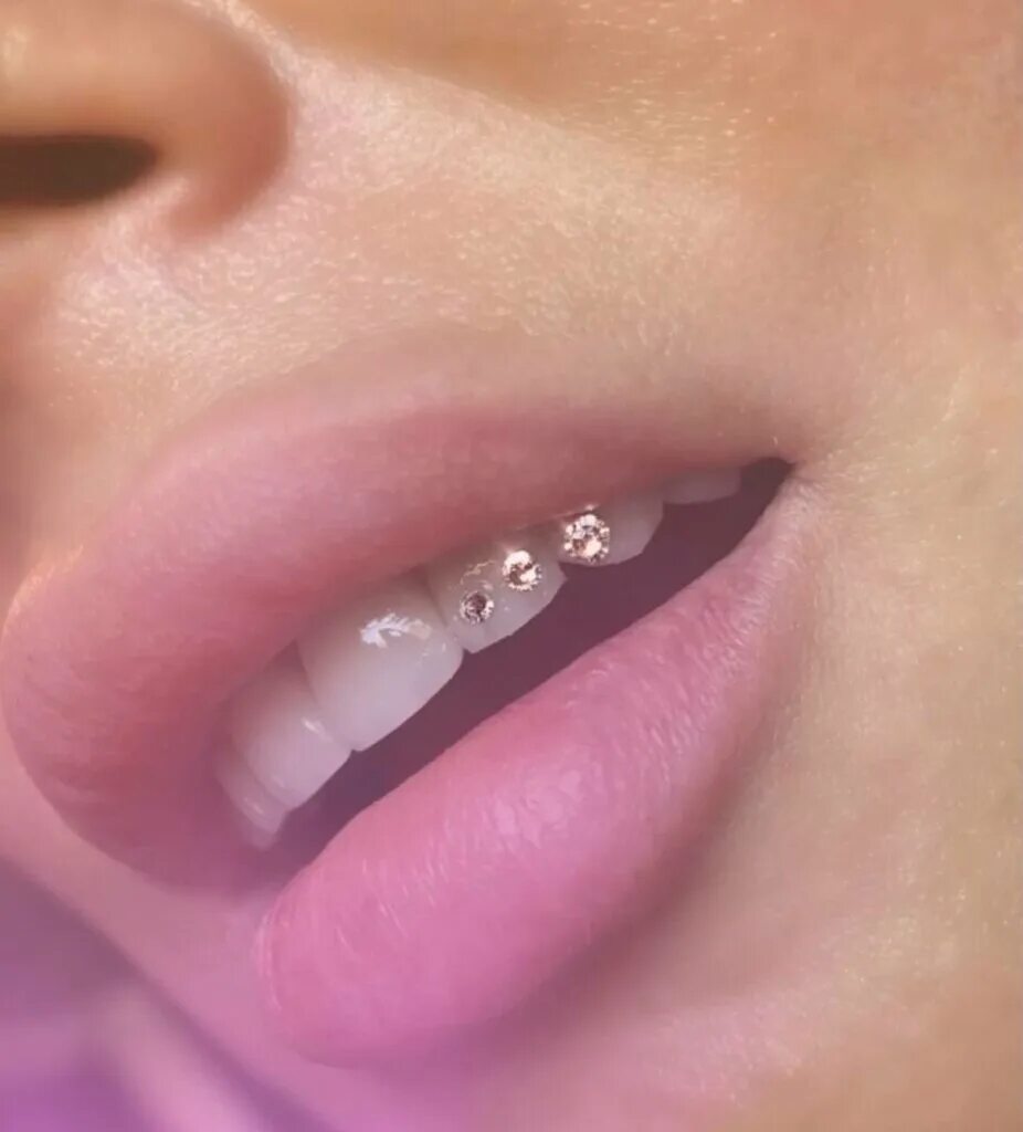 Как установить скайсы. Украшение зубов скайсами. Украшения для зубов скайсы. Как установить скайсы. Как установить скайсы.