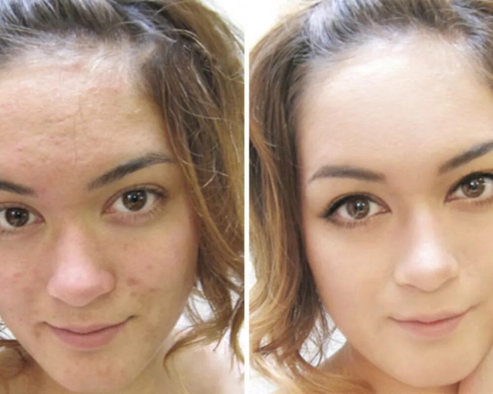 Неровный цвет лица. Проблемная кожа до и после.