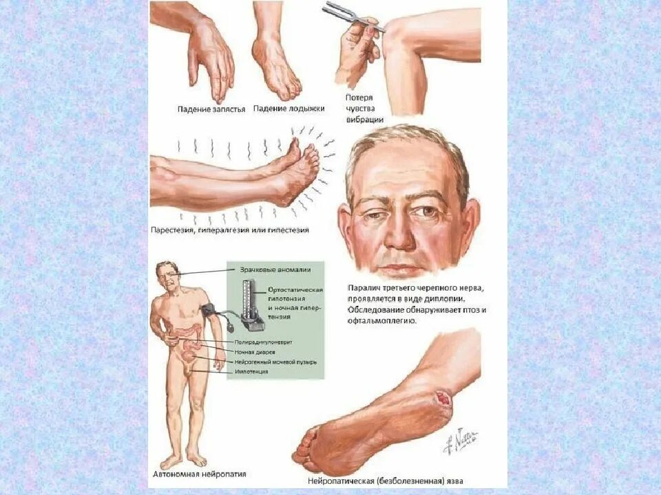 Невропатия аксонального типа. Диабетическая полинейропатия клиническая картина. Диабетическая дистальная полинейропатия формы. Автономная диабетическая нейропатия. Автономная нейропатия при сахарном диабете.