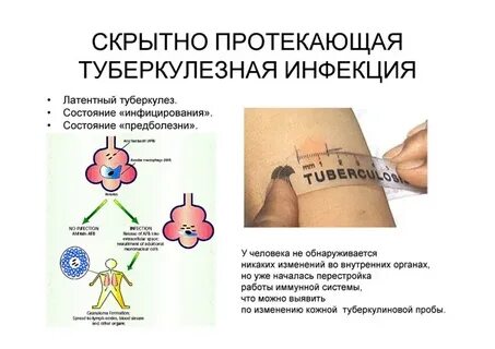 Тест проба туберкулез