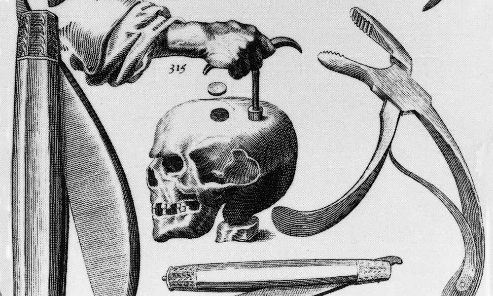 Хирургия эпохи возрождения. Инструменты для трепанации черепа. Древняя Трепанация черепа. Манипуляция Трепанация черепа. Коловорот для трепанации черепа.