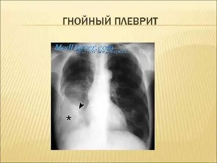 Эмпиема легкого