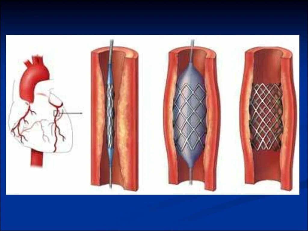 Стентирование видео. Баллонная коронарная ангиопластика. Коронарография стентирование. Стентирование сосудов сердца.