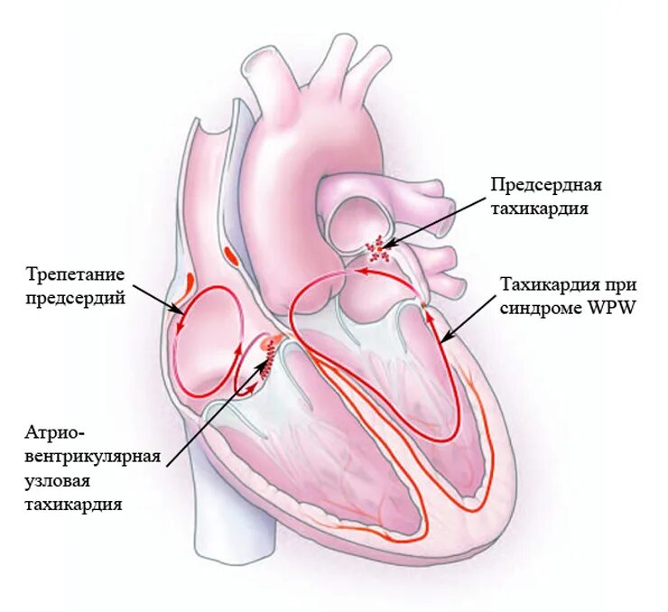 Тахикардия. Наджелудочковый гребень. Тахикардия сердца. Частое сердцебиение. Предсердие желудка