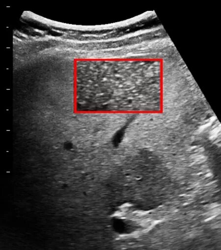 Small Animal Abdominal Ultrasonography, Part 2: Liver and Gallbladder Today's Ve