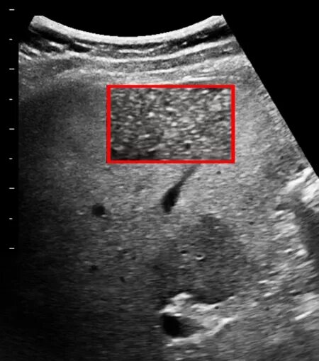 Структурные изменения печени. Снимки печени УЗИ жировой гепатоз. Жировой гепатоз при УЗИ. Очаговый липоматоз печени УЗИ. Жировой гепатоз УЗИ картина.