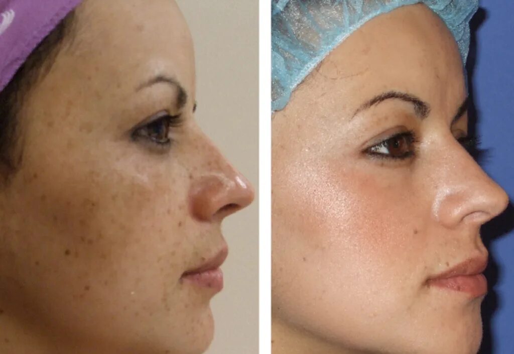 Пилинг для лица. Чистка лица реклама. Алмазная шлифовка лица протокол процедуры. Пилинг тса 30. Голливудский пилинг джесснера.