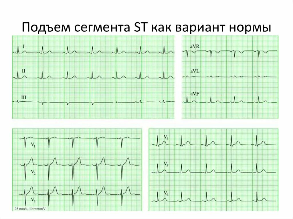 Подъём сегмента St на ЭКГ В v1-v4. Подъем сегмента St в AVR. Подъем сегмента St в AVR на ЭКГ. Подъем сегмента St на ЭКГ v1 v2. Отведение v1 на экг