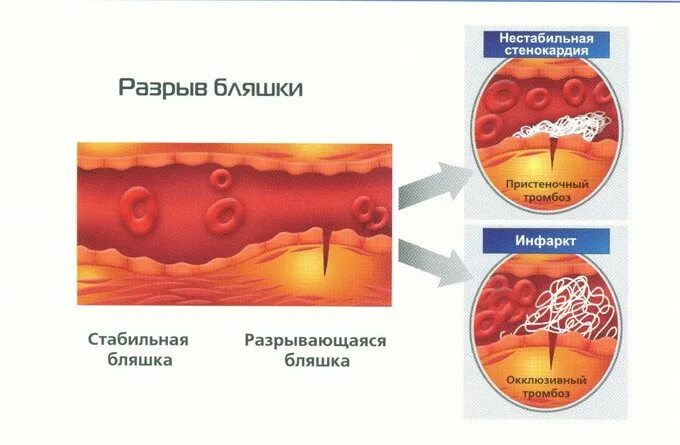 Разрыв бляшки